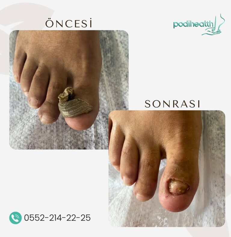 Ayak Tırnak Kalınlaşması Nasıl Geçer?