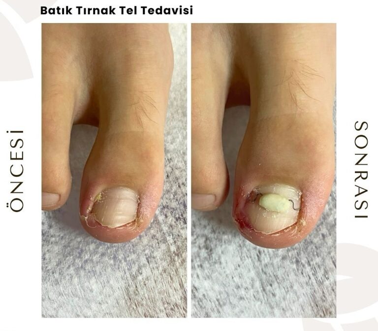 Tırnak Batması Ameliyat Olmadan Nasıl Geçer?