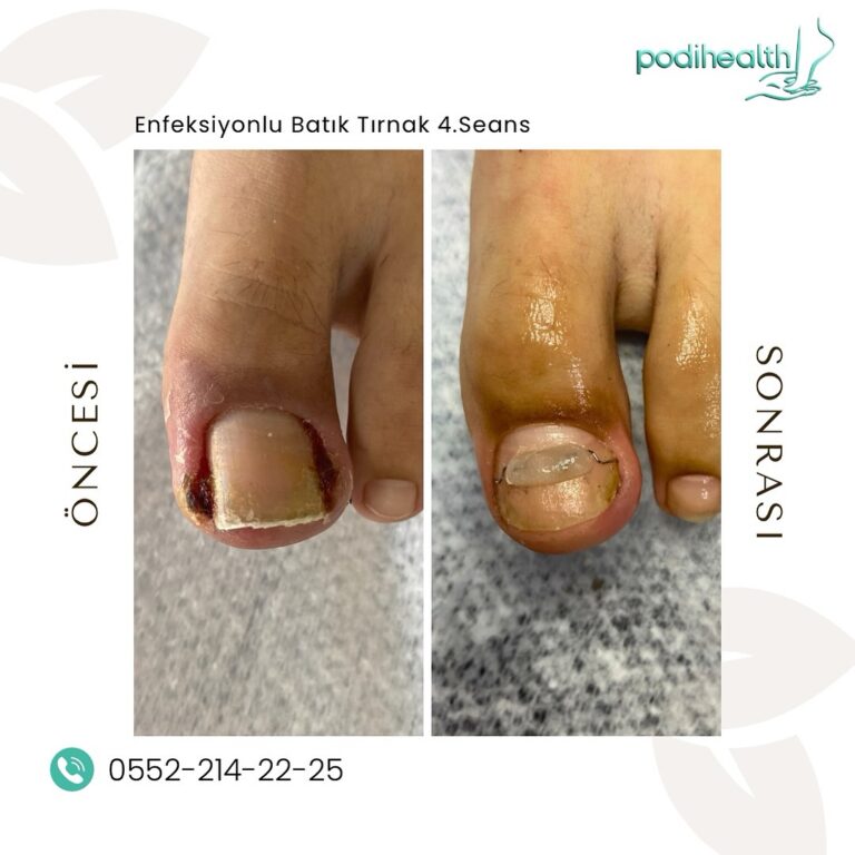 Ayak Baş Parmak Tırnak Batması Neden Olur?