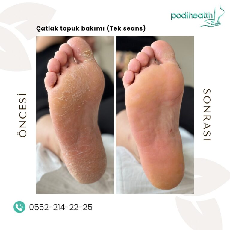 Ayak Çatlak Tedavisi – Sağlıklı ve Pürüzsüz Ayaklar