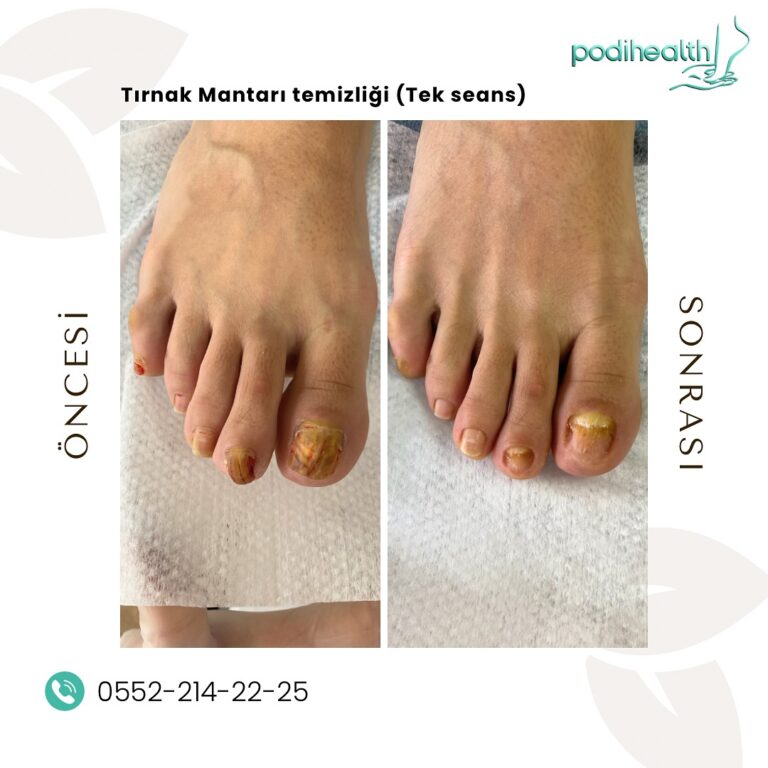 Ayak Baş Parmak Tırnak Kalınlaşması